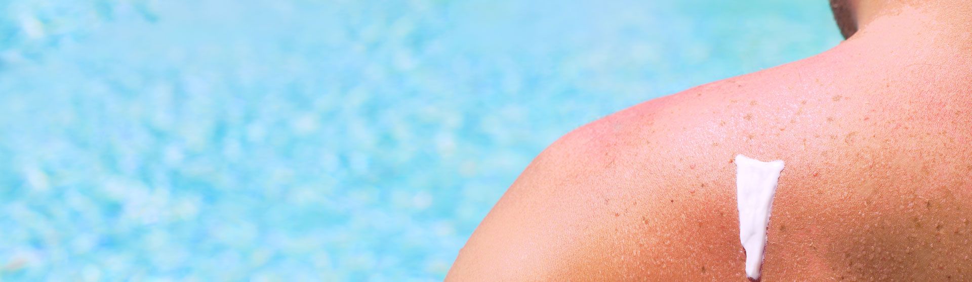 Mann mit Sonnencreme am Rücken steht am Pool.