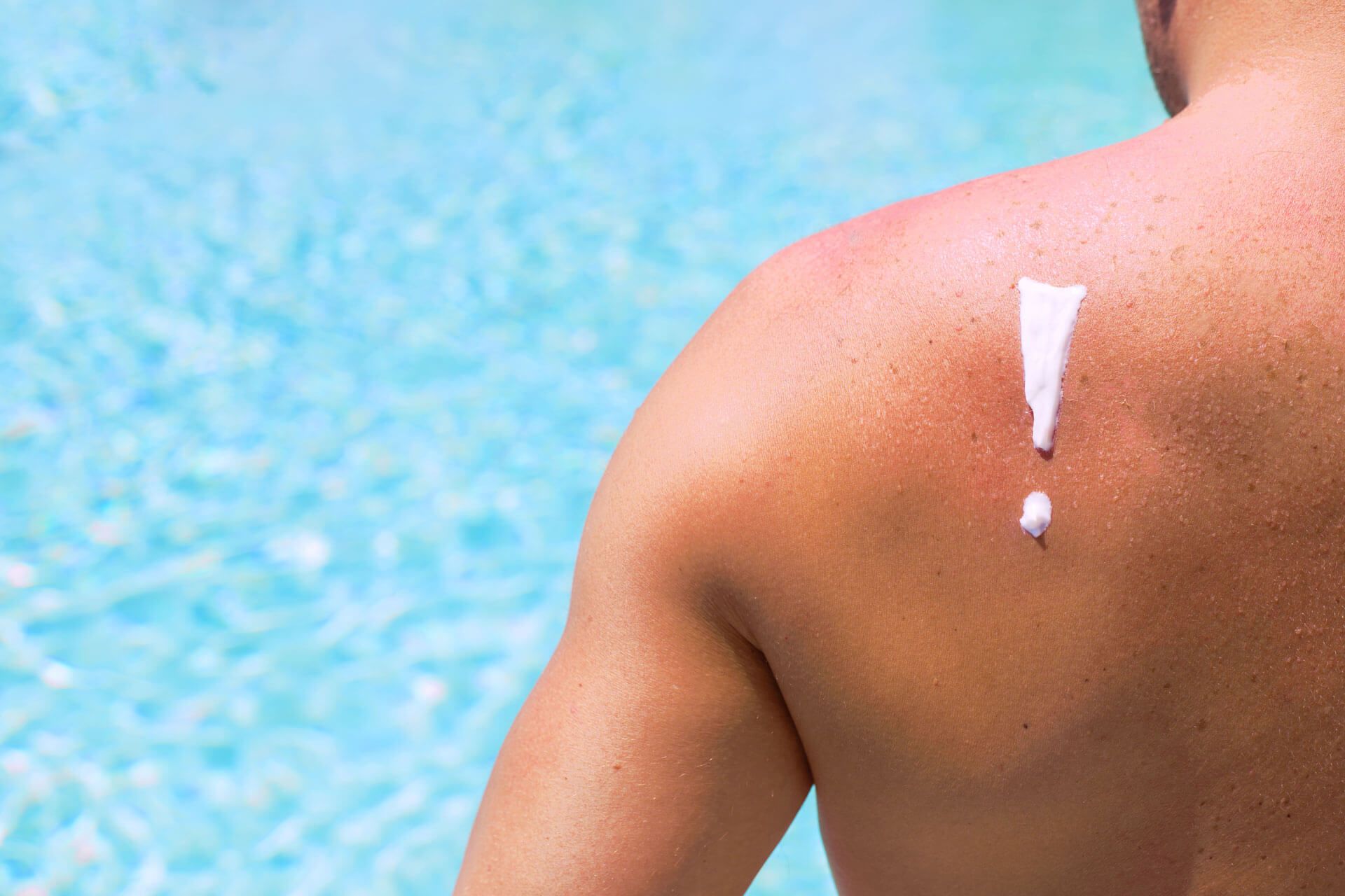 Mann mit Sonnencreme am Rücken steht am Pool.